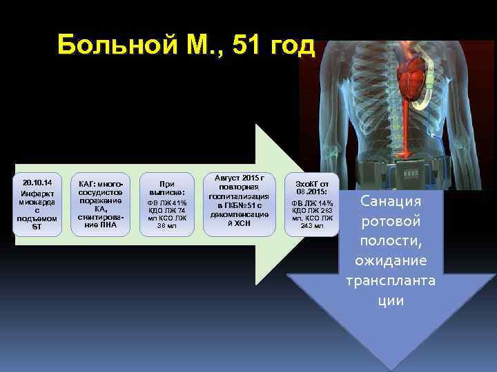 Больной М. , 51 год 20. 14 Инфаркт миокарда с подъемом ST КАГ: многососудистое