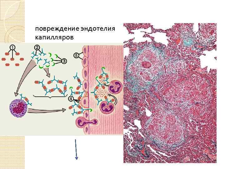 повреждение эндотелия капилляров 