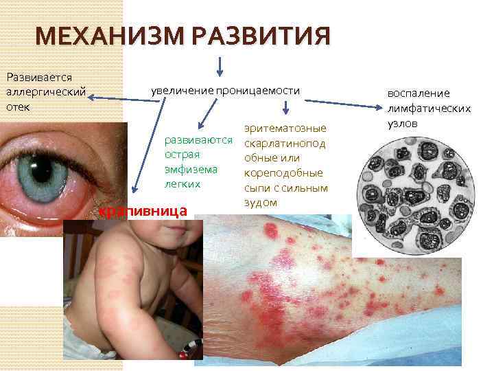 МЕХАНИЗМ РАЗВИТИЯ Развивается аллергический отек увеличение проницаемости эритематозные развиваются скарлатинопод острая обные или эмфизема