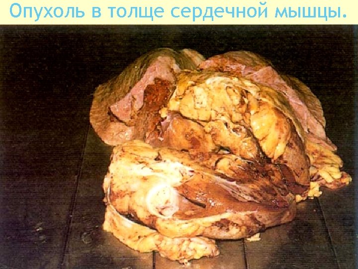 Опухоль в толще сердечной мышцы. 