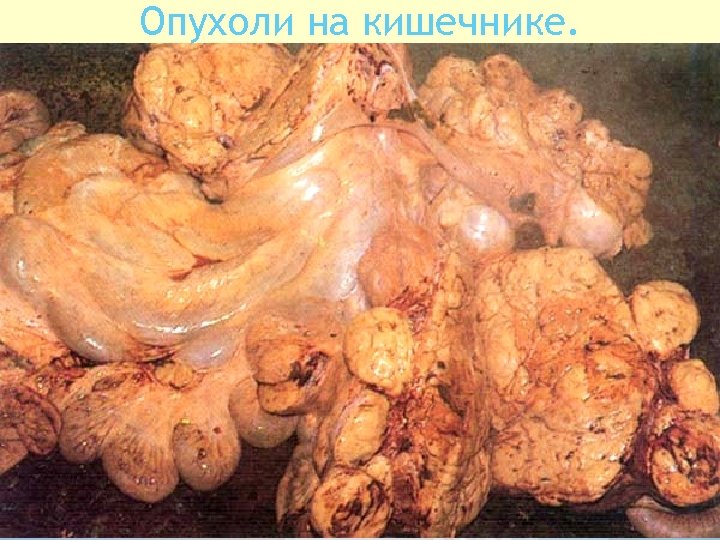 Опухоли на кишечнике. 