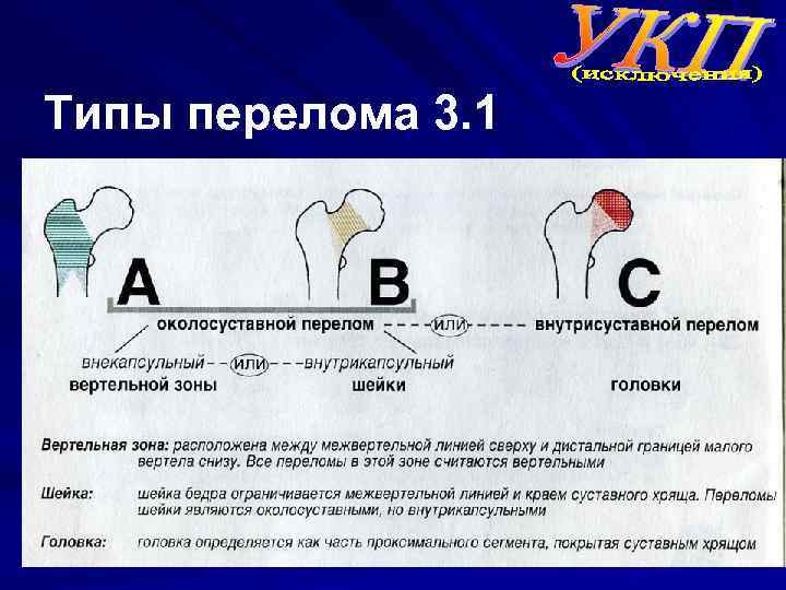 Типы перелома 3. 1 