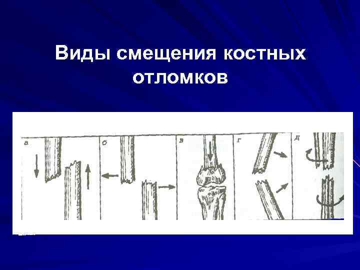 Смещение отломков кости