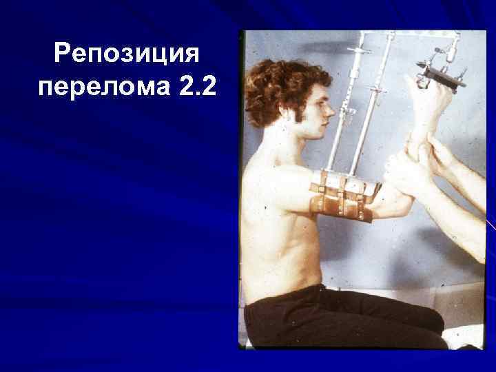 Репозиция перелома 2. 2 