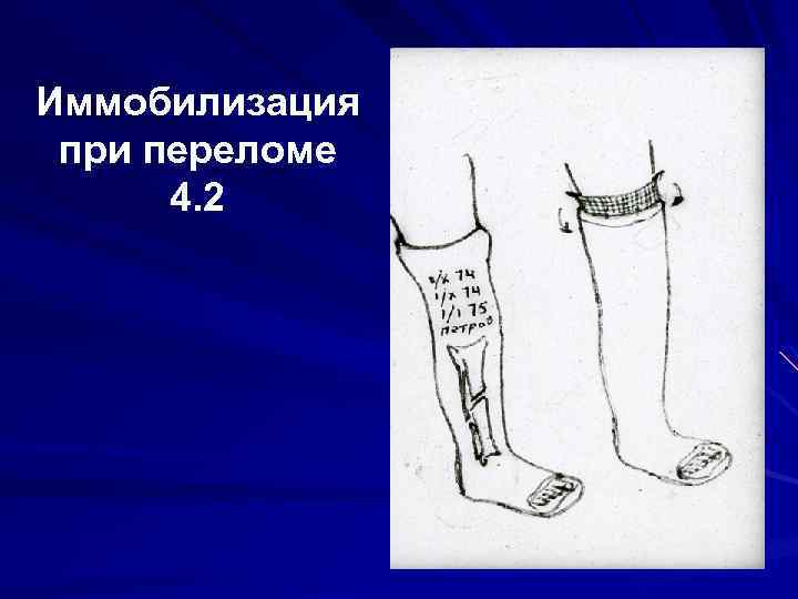 Иммобилизация при переломе 4. 2 