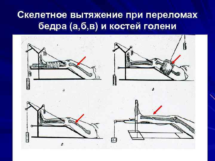 Вытяжение голени. Шина Беллера для скелетного вытяжения. Схема скелетного вытяжения при переломах бедренной кости. Скелетное вытяжение бедренной кости. Скелетная вытяжка при переломе.