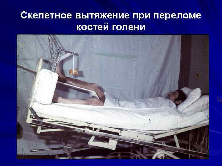 Скелетное вытяжение при переломе костей голени 