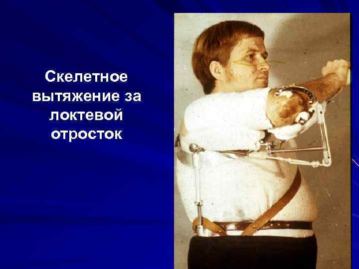 Скелетное вытяжение за локтевой отросток 