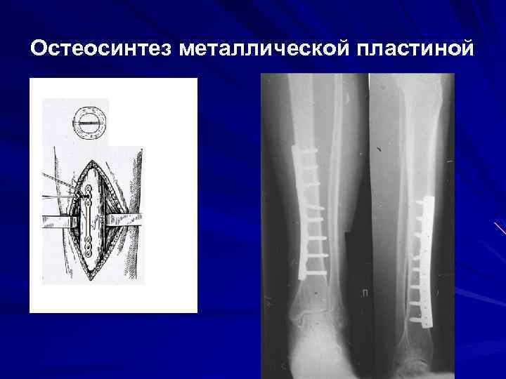 Остеосинтез металлической пластиной 