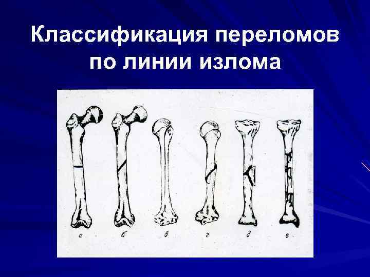 Виды переломов. Классификация переломов по линии перелома. Типы переломов по линии излома. Классификация переломов по плоскости излома. Классификация переломов со смещением.