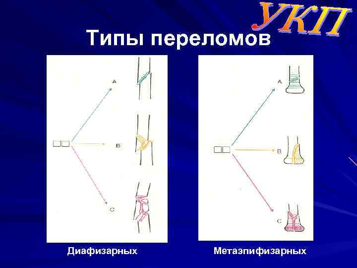 Типы переломов Диафизарных Метаэпифизарных 