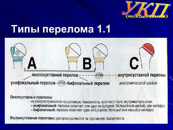 Типы перелома 1. 1 