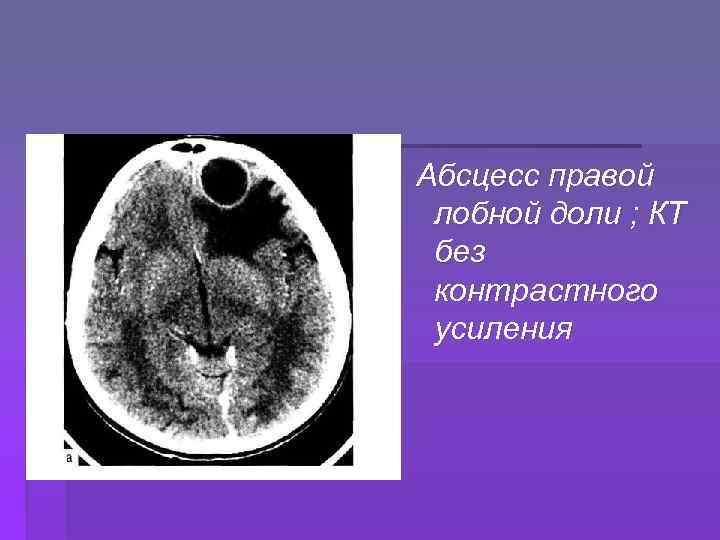 Абсцесс мозга симптомы. Кт абсцесс височной доли. Кт при абсцессе головного мозга.