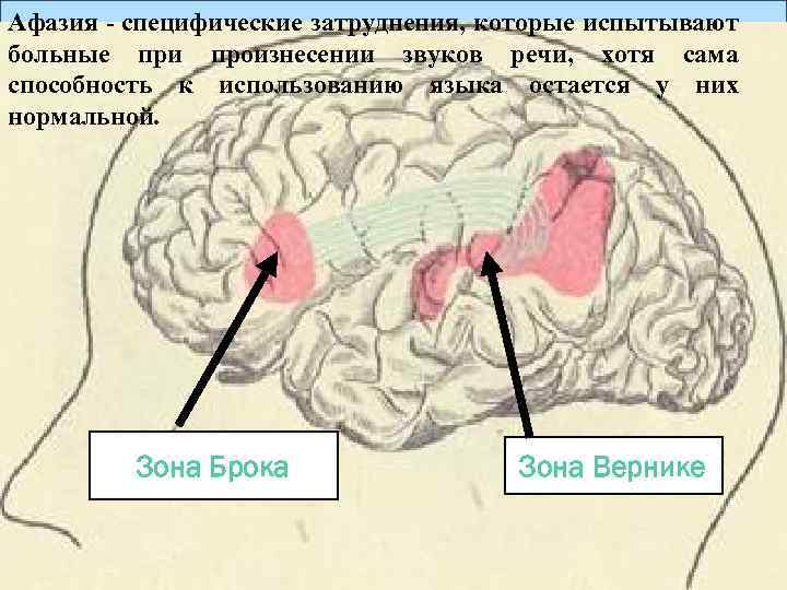 Афазия - специфические затруднения, которые испытывают больные при произнесении звуков речи, хотя сама способность