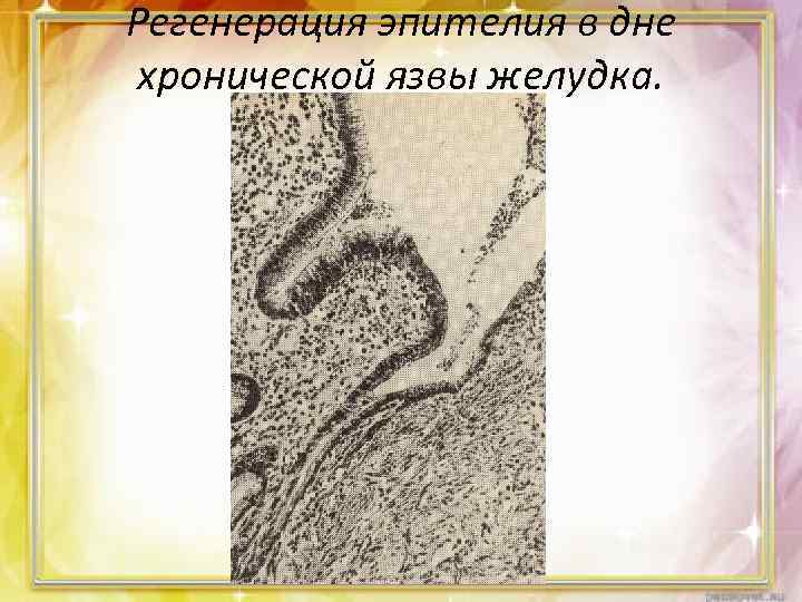 Регенерация эпителия в дне хронической язвы желудка. 