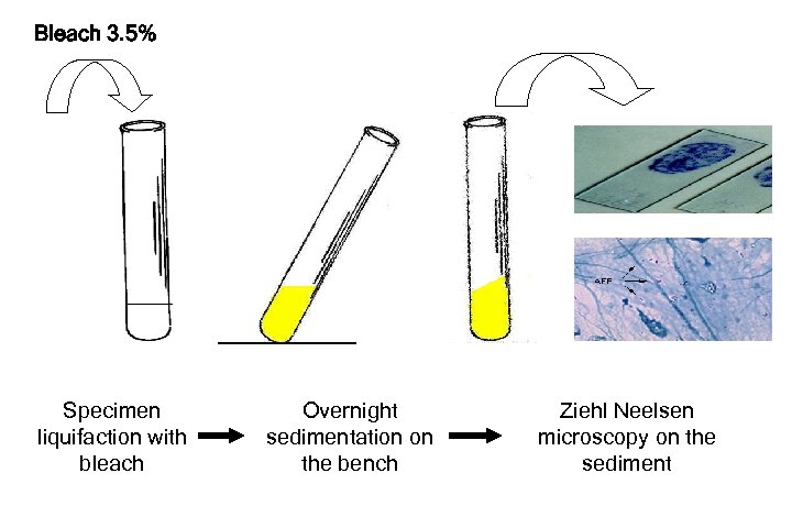 Bleach 3. 5% Specimen liquifaction with bleach Overnight sedimentation on the bench Ziehl Neelsen