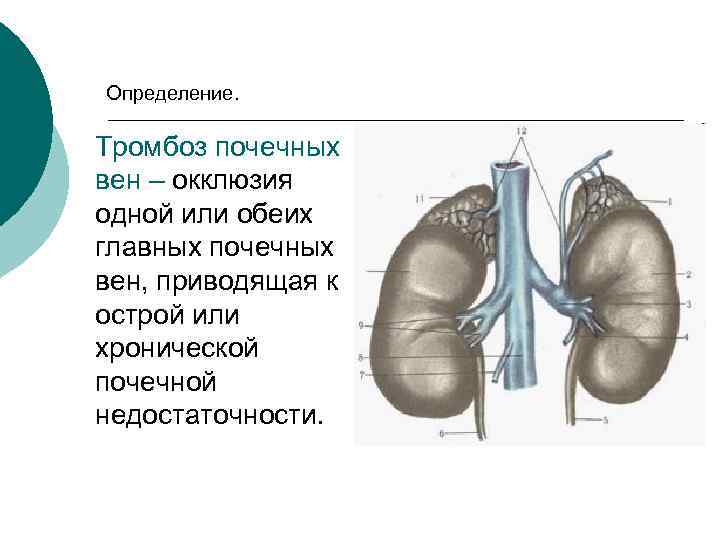 Определение. Тромбоз почечных вен – окклюзия одной или обеих главных почечных вен, приводящая к