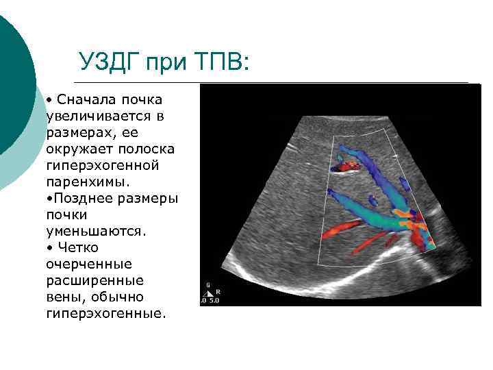 УЗДГ при ТПВ: • Сначала почка увеличивается в размерах, ее окружает полоска гиперэхогенной паренхимы.