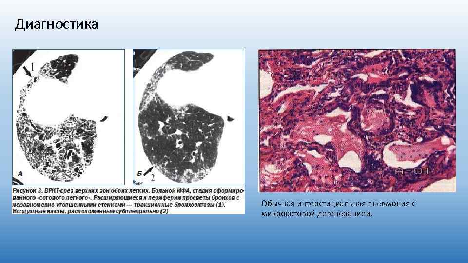 Диагностика Обычная интерстициальная пневмония с микросотовой дегенерацией. 