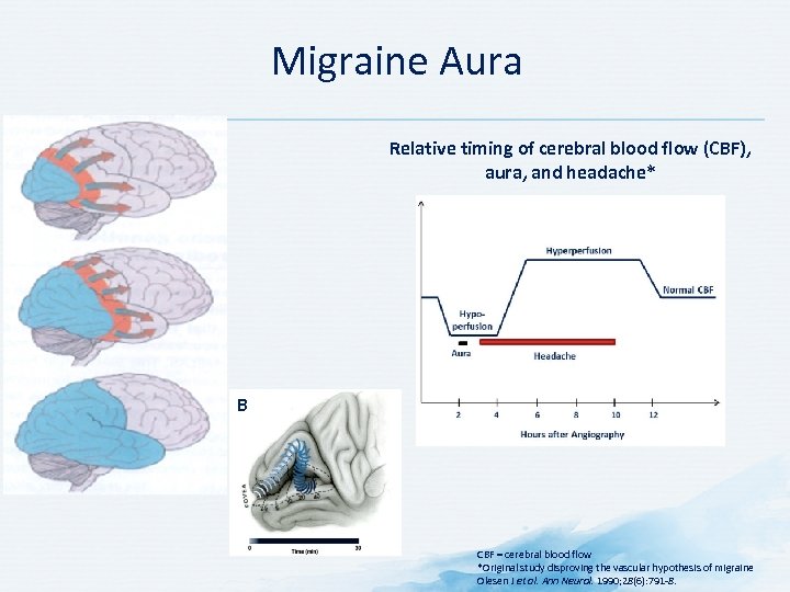 Migraine Aura Relative timing of cerebral blood flow (CBF), aura, and headache* B CBF