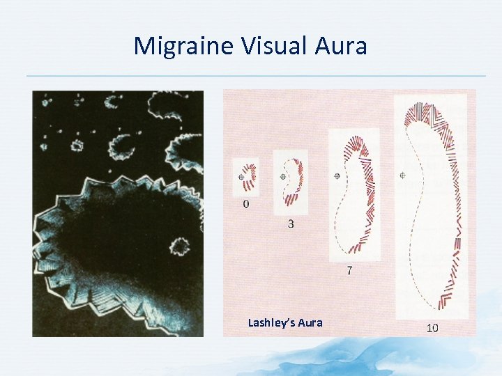 Migraine Visual Aura Lashley’s Aura 