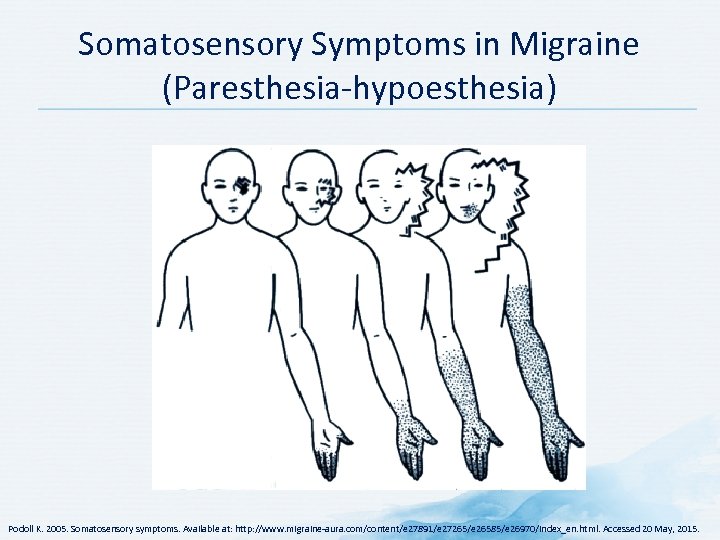 Somatosensory Symptoms in Migraine (Paresthesia hypoesthesia) Podoll K. 2005. Somatosensory symptoms. Available at: http: