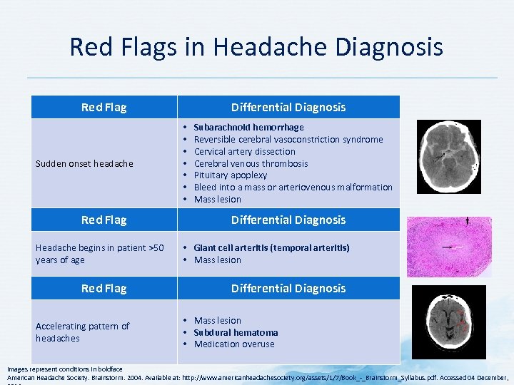 Red Flags in Headache Diagnosis Red Flag Sudden onset headache Red Flag Headache begins