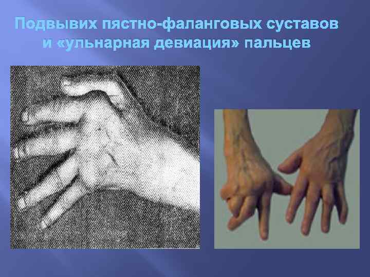 Подвывих пястно-фаланговых суставов и «ульнарная девиация» пальцев 