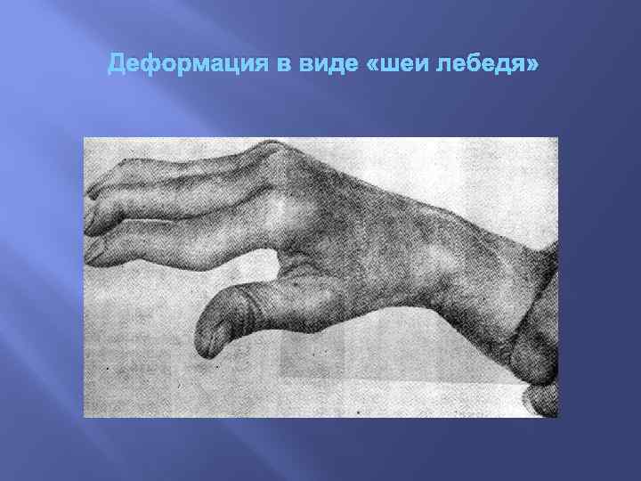 Деформация в виде «шеи лебедя» 