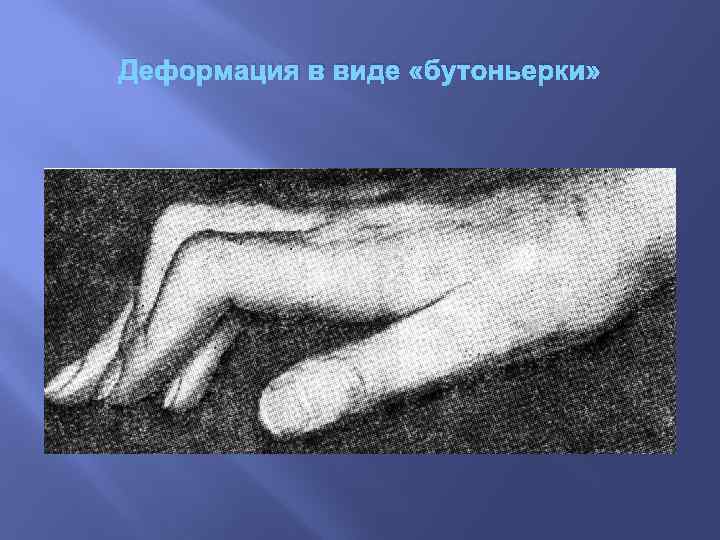 Деформация в виде «бутоньерки» 