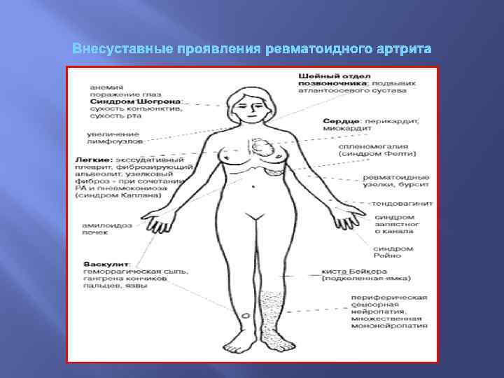 Внесуставные проявления ревматоидного артрита 