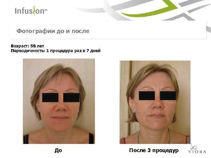 Фотографии до и после Возраст: 58 лет Переодичность: 1 процедура раз в 7 дней