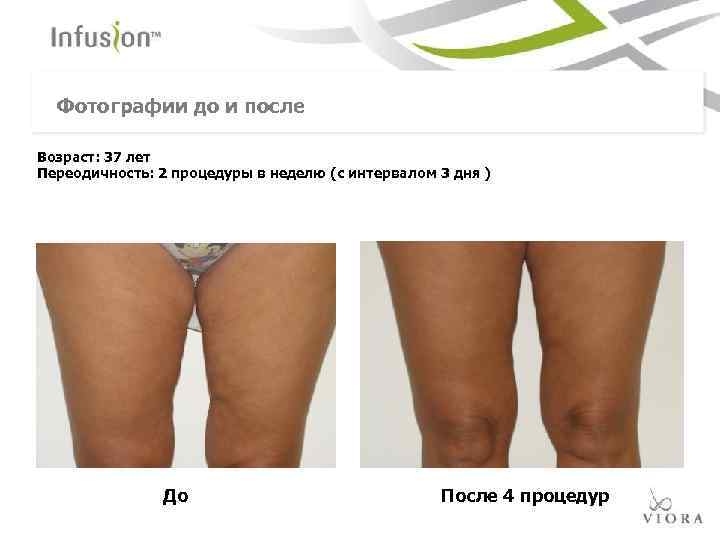 Фотографии до и после Возраст: 37 лет Переодичность: 2 процедуры в неделю (с интервалом