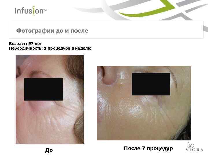 Фотографии до и после Возраст: 57 лет Переодичность: 1 процедура в неделю До После