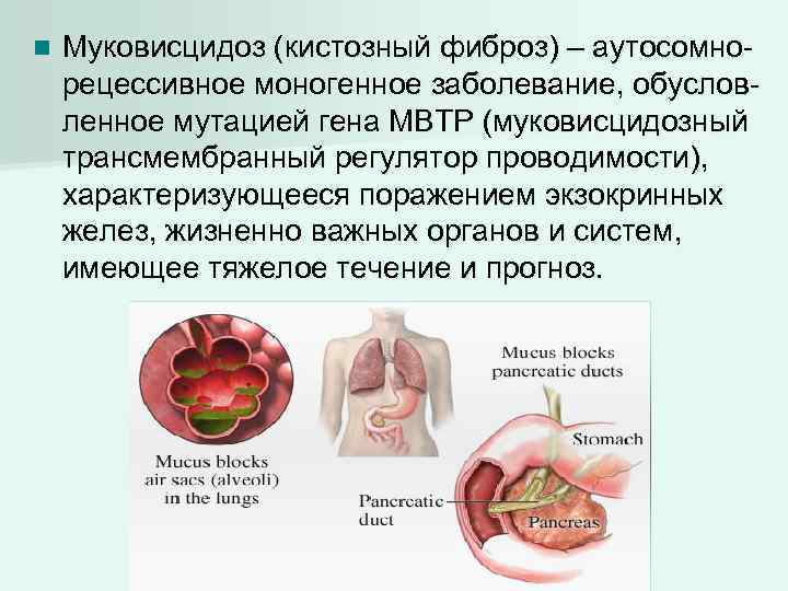 Муковисцидоз наследственная болезнь обусловленная аутосомным рецессивным геном клиническая картина