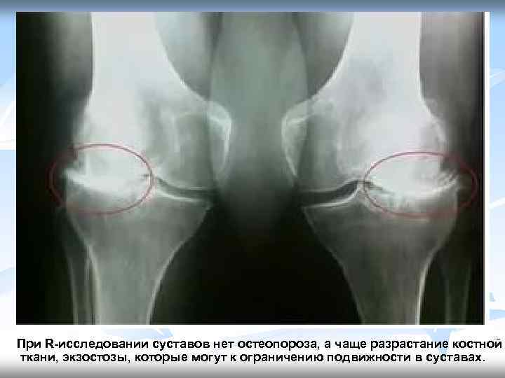 При R-исследовании суставов нет остеопороза, а чаще разрастание костной ткани, экзостозы, которые могут к