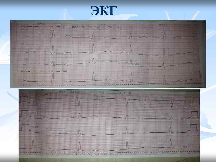 ЭКГ 