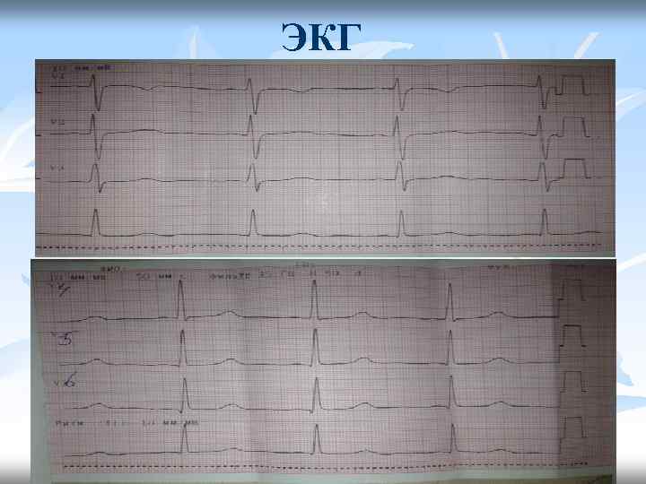 ЭКГ 