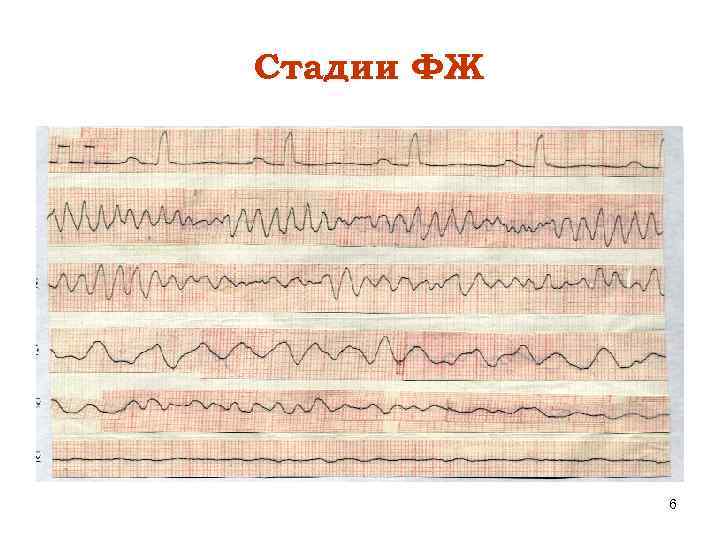 Стадии ФЖ 6 