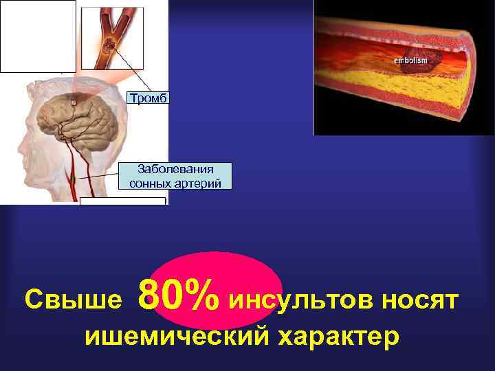 Тромб Заболевания сонных артерий Свыше 80% инсультов носят ишемический характер 