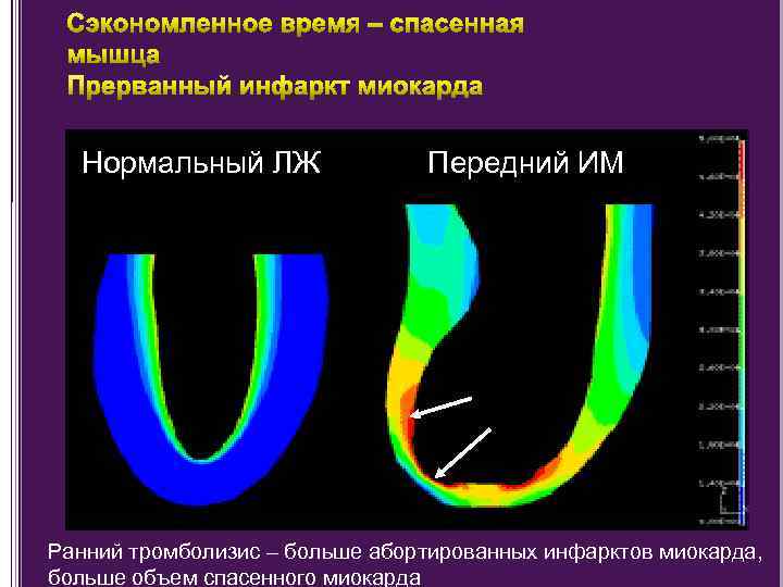 Нормальный ЛЖ Передний ИМ Ранний тромболизис – больше абортированных инфарктов миокарда, больше объем спасенного