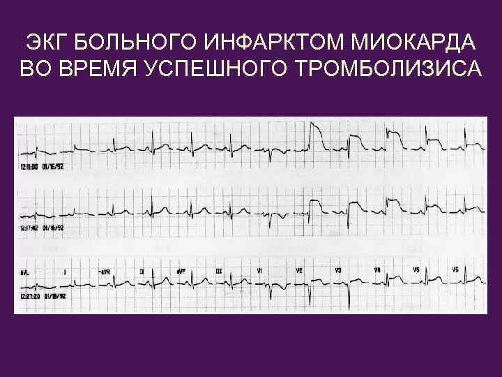 ЭКГ БОЛЬНОГО ИНФАРКТОМ МИОКАРДА ВО ВРЕМЯ УСПЕШНОГО ТРОМБОЛИЗИСА 