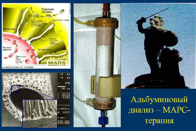 Альбуминовый диализ – МАРСтерапия 