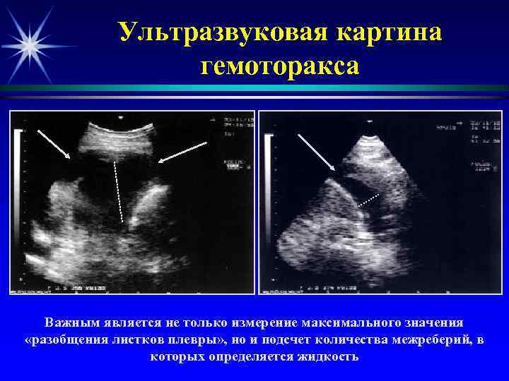 Ультразвуковая картина гемоторакса Важным является не только измерение максимального значения «разобщения листков плевры» ,