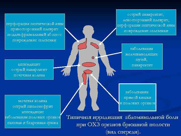 перфорация пептической язвы правосторонний плеврит поддиафрагмальный абсцесс повреждение селезенки аппендицит острый панкреатит почечная колика