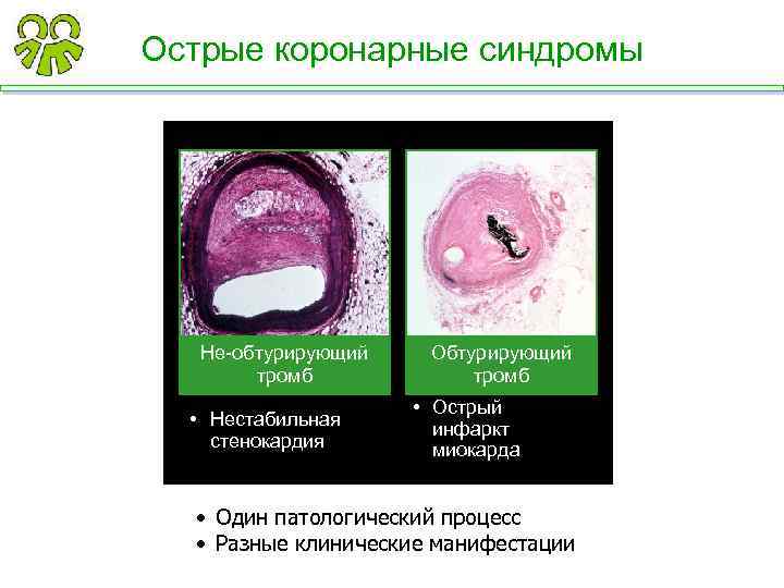 Острые коронарные синдромы Не-обтурирующий тромб • Нестабильная стенокардия Обтурирующий тромб • Острый инфаркт миокарда