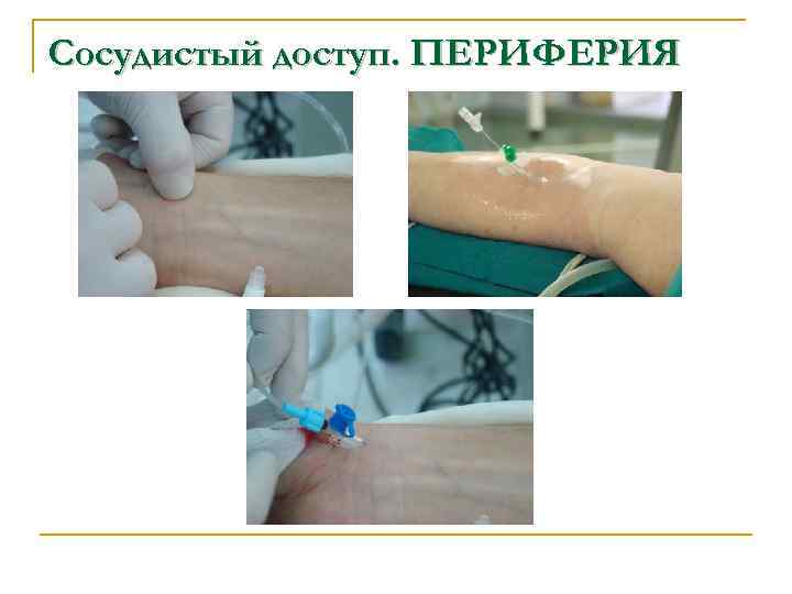Сосудистый доступ. ПЕРИФЕРИЯ 