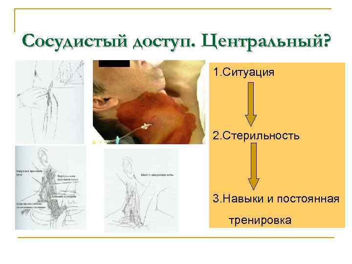 Сосудистый доступ. Центральный? 1. Ситуация 2. Стерильность 3. Навыки и постоянная тренировка 
