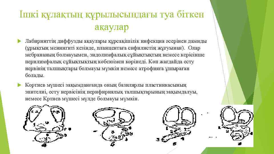 Ішкі құлақтың құрылысындағы туа біткен ақаулар Лабиринттің диффузды ақаулары құрсақішілік инфекция әсерінен дамиды (ұрықтың
