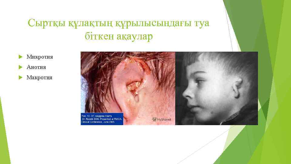 Сыртқы құлақтың құрылысындағы туа біткен ақаулар Микротия Анотия Макротия 